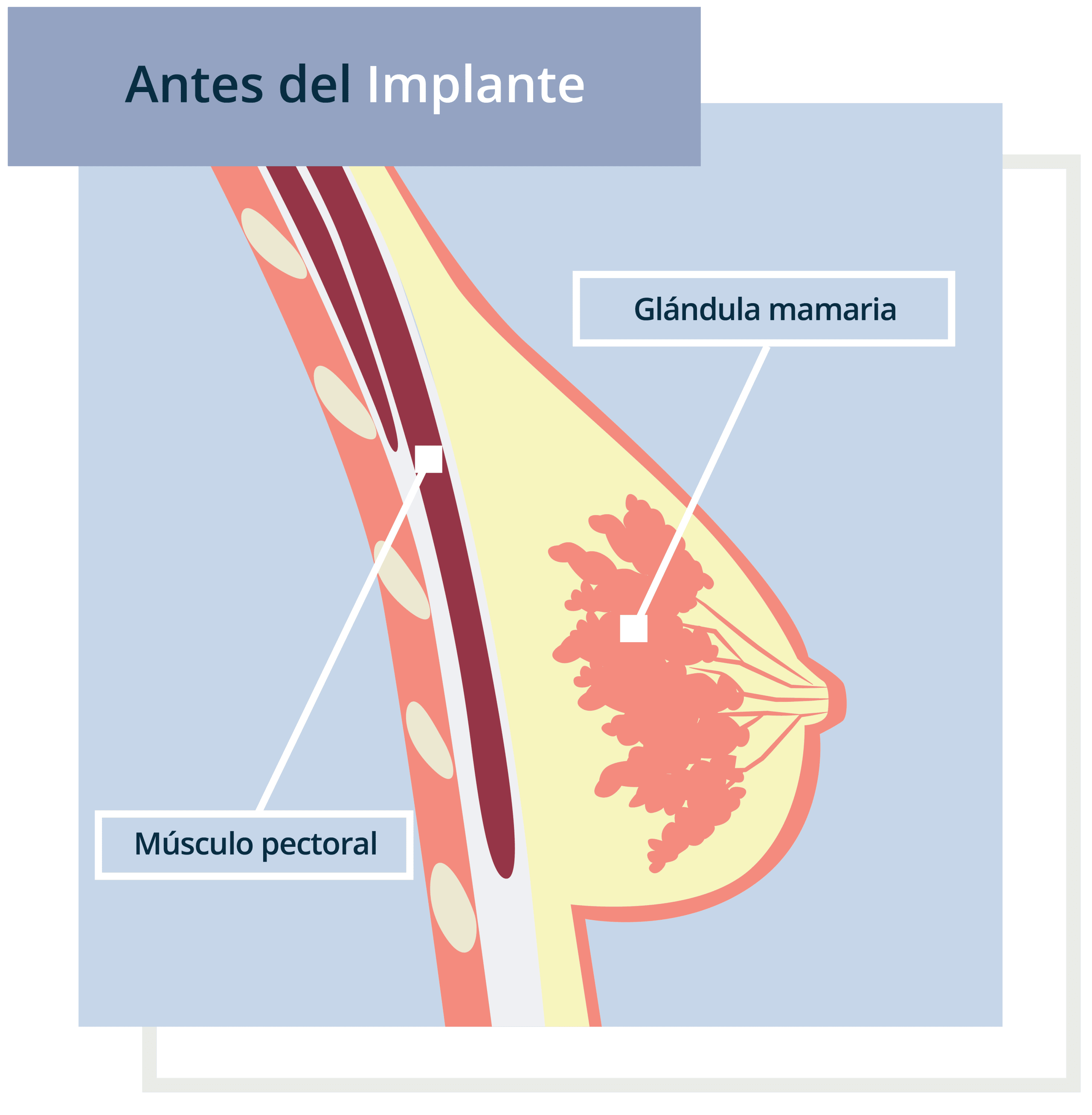 implante-mamario-03