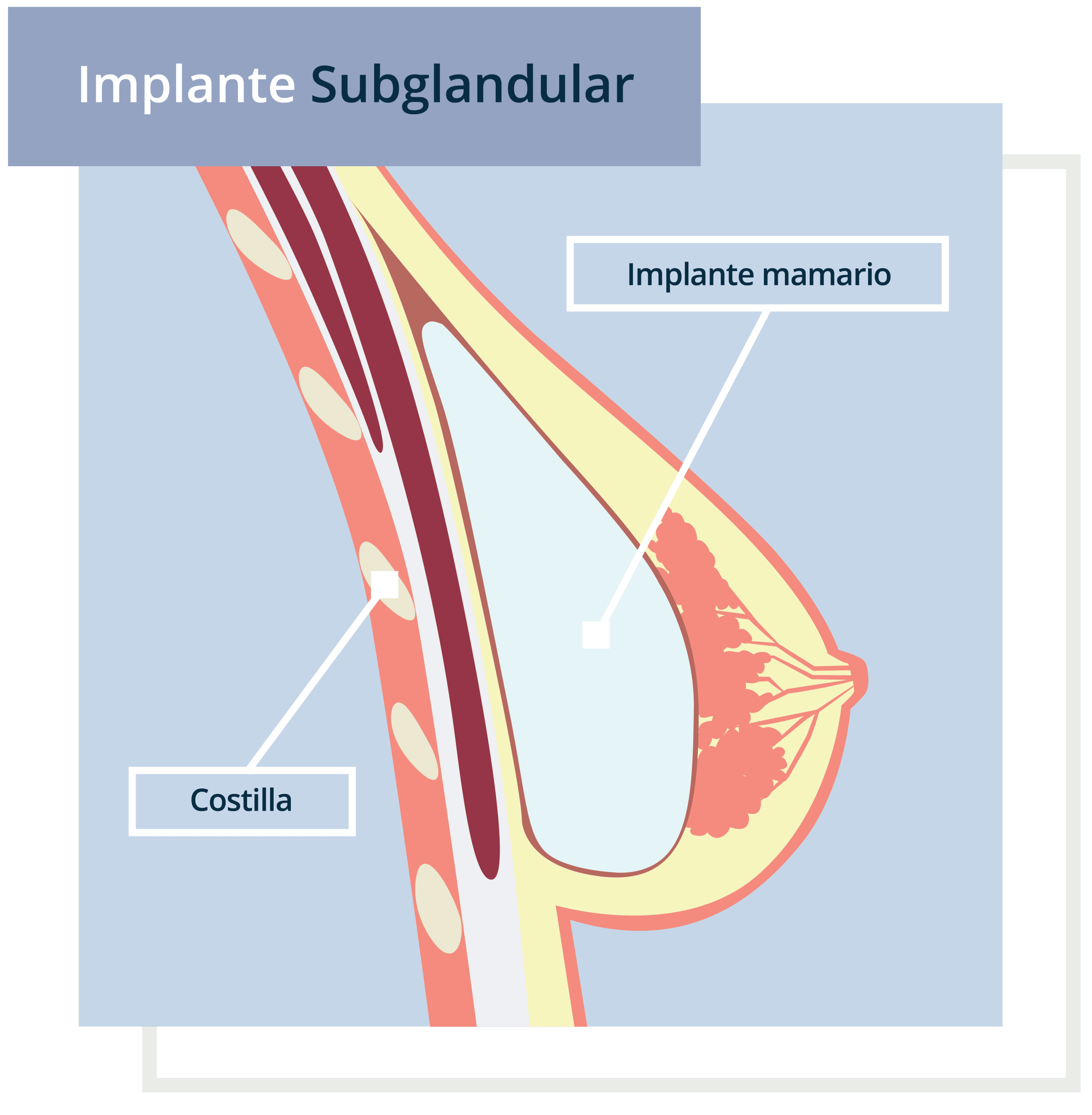 implante-mamario-04