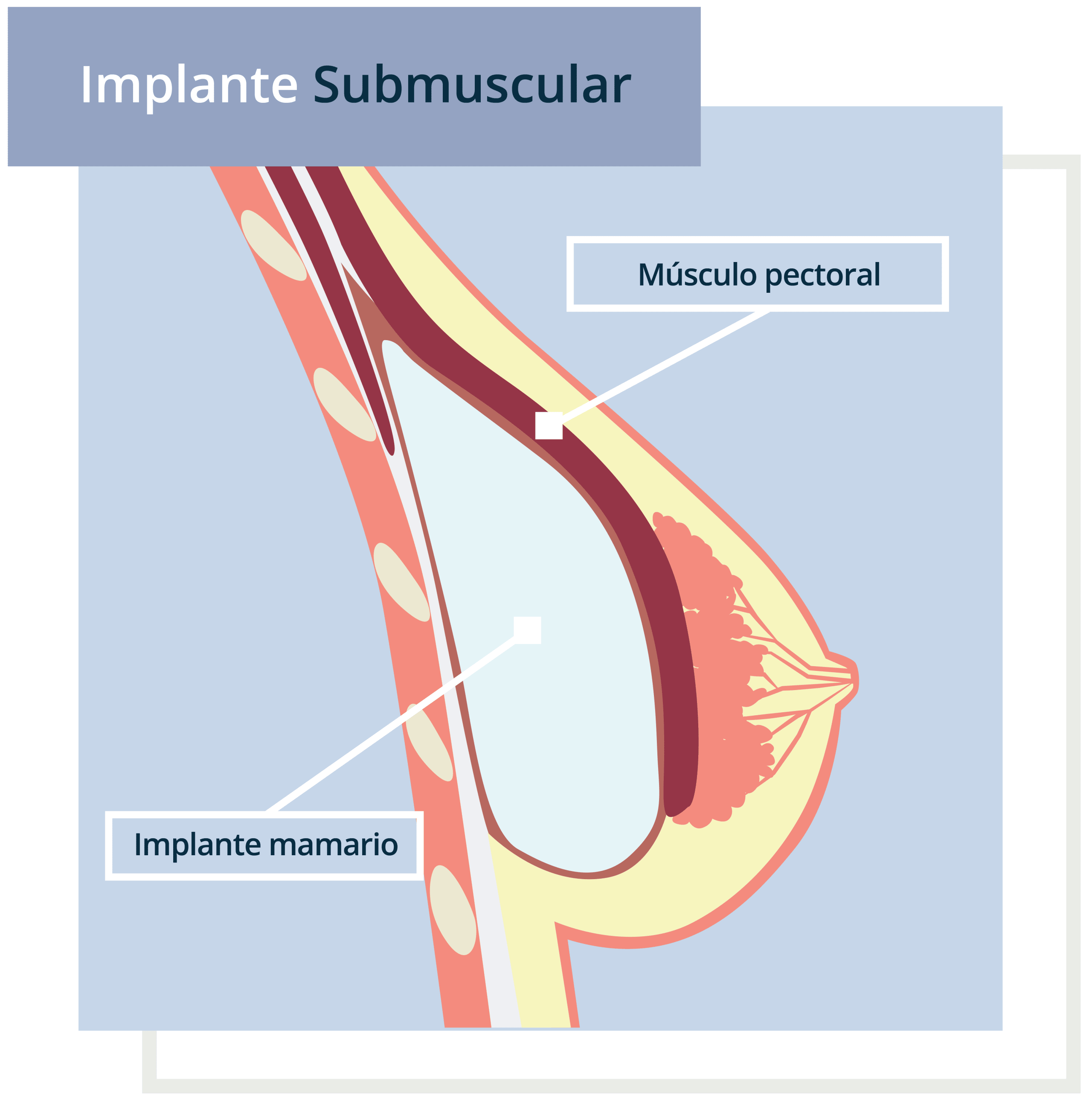 implante-mamario-05